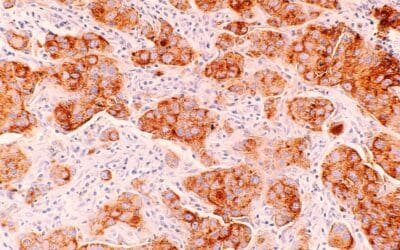 Cancer: On The Rise But Still Preventable